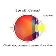 Cataracts Treatment in Riverdale, NJ