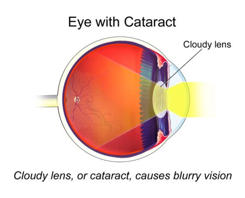 Cataracts Treatment in Riverdale, NJ