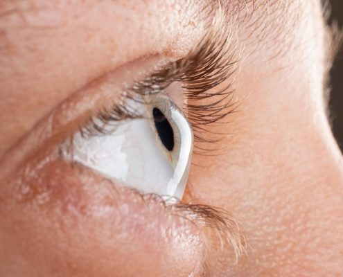 female-eye-diagnosed-with-keratoconus-corneal-thinning