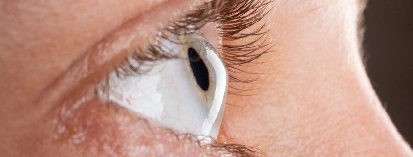 female-eye-diagnosed-with-keratoconus-corneal-thinning